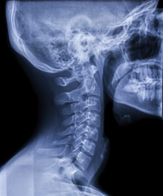 Online Pain Management X-Ray of Neck 